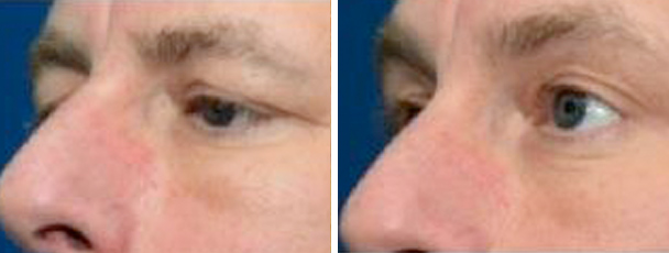 man face before and after patient left side photo 9