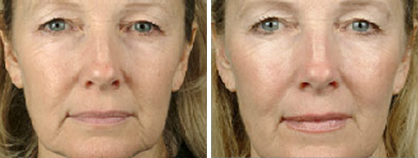 woman face before and after patient front photo 13