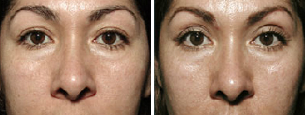 woman face before and after patient front photo 14