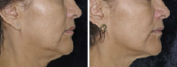 woman face before and after patient right side photo 15