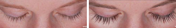 woman face before and after patient eyes front photo 18