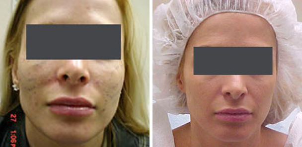 woman face before and after patient front photo 1