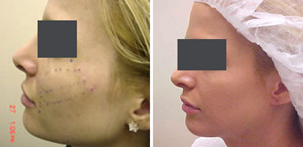 woman face before and after patient left side photo 3