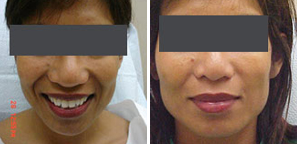 woman face before and after patient front photo 5