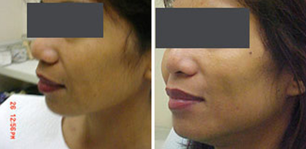 woman face before and after patient left side photo 6