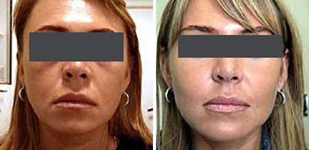 woman face before and after patient front photo 7